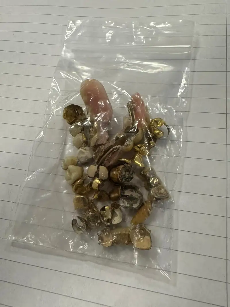 Kundenfoto: Zahngold mit Kronen und Brückenteilen in einem Druckverschlussbeutel